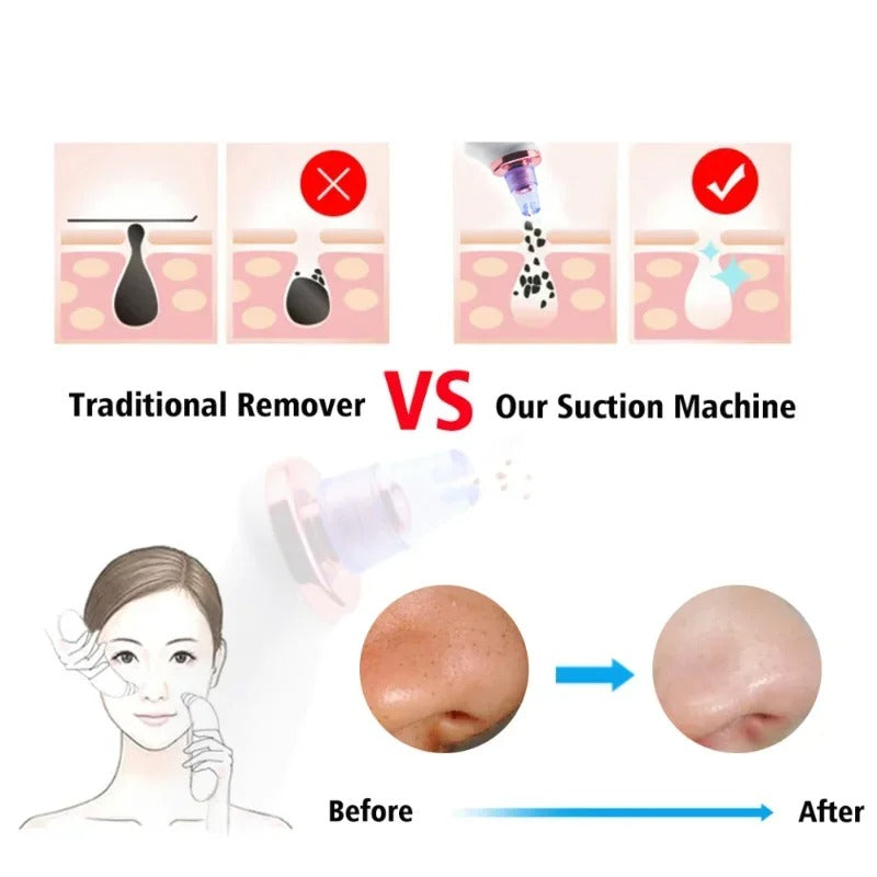 Electric Blackhead Remover
